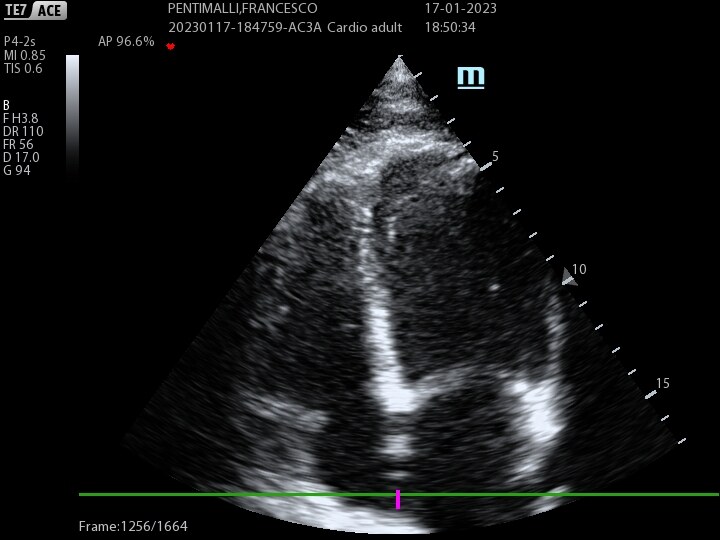 Ecocardiogramma color-doppler